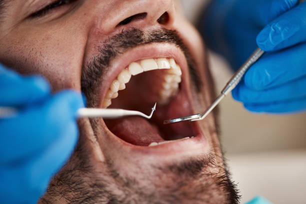 Best Emergency Root Canal Treatment in Keshore, LA